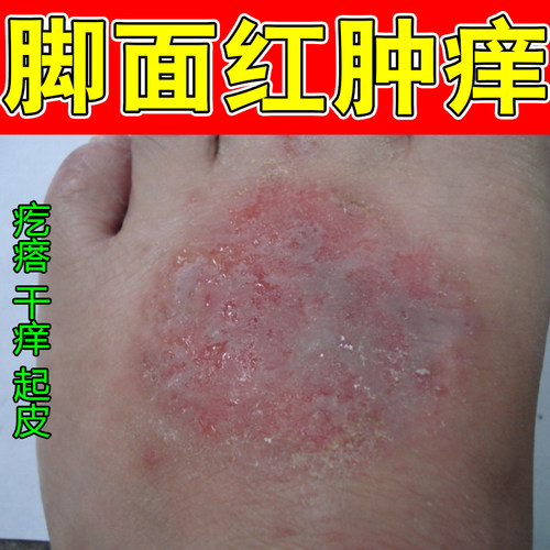脚面红肿痒湿红皮肤干燥粗糙过敏紫外线起小脚背脚杆红点