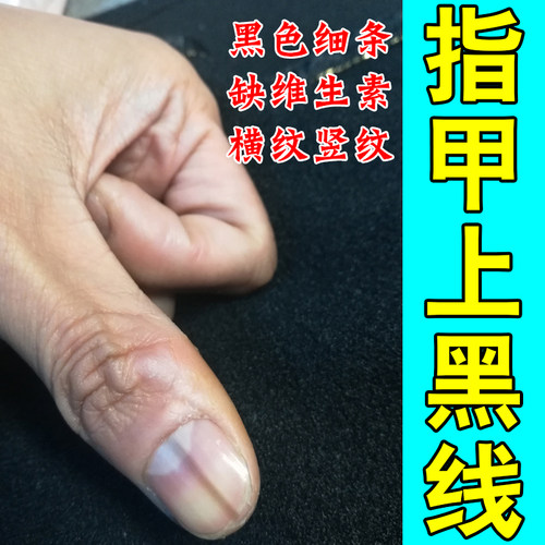 指甲黑线长竖纹空甲甲受损甲母痣