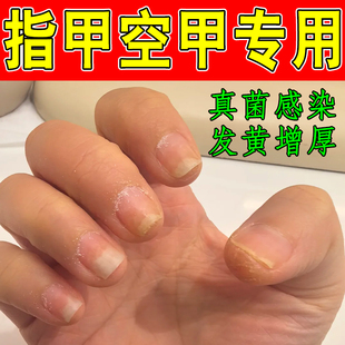 指甲空甲专用指甲变黄浑浊变脆变薄粗糙冶真菌性白甲指甲凹凸不平