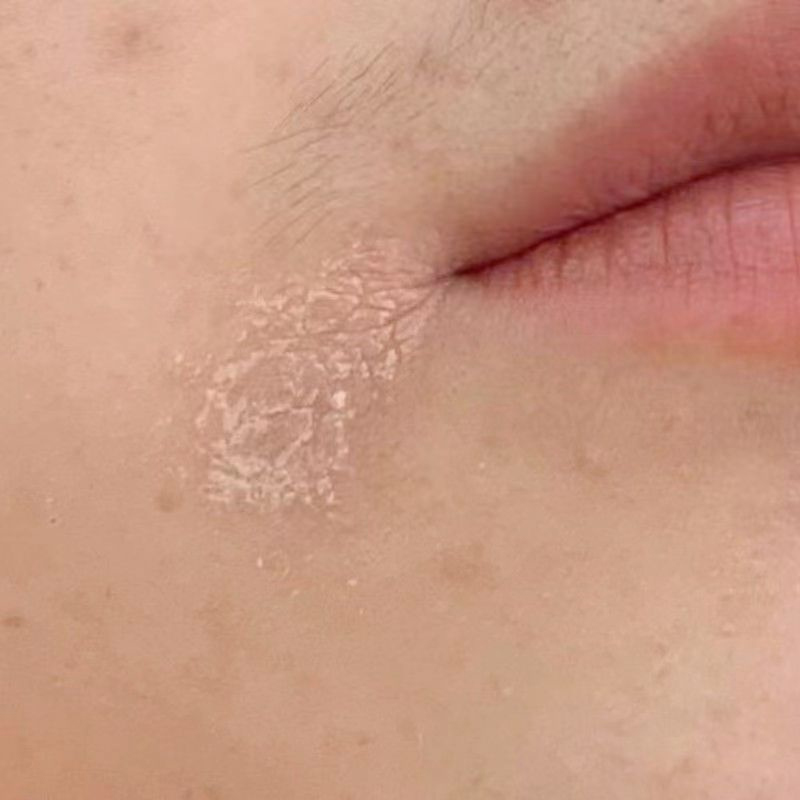 脸上起皮干燥脸干掉皮发痒秋冬季面部面部干刺痒脱皮皮肤粗糙卡粉