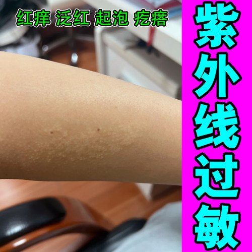 过敏皮肤痒身上长红疙瘩脖子手臂刺挠专用修复药乳