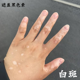 白殿风外用药外用膏黑色素生长补骨脂酊专用进口遮盖液快速消白斑