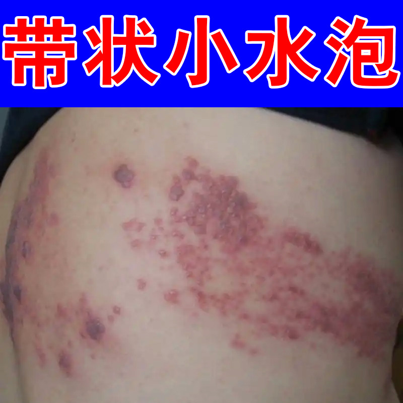 胸腰部位成片水泡疙瘩难受蛇盘疮肌肤日常护理皮肤表层舒缓外用药