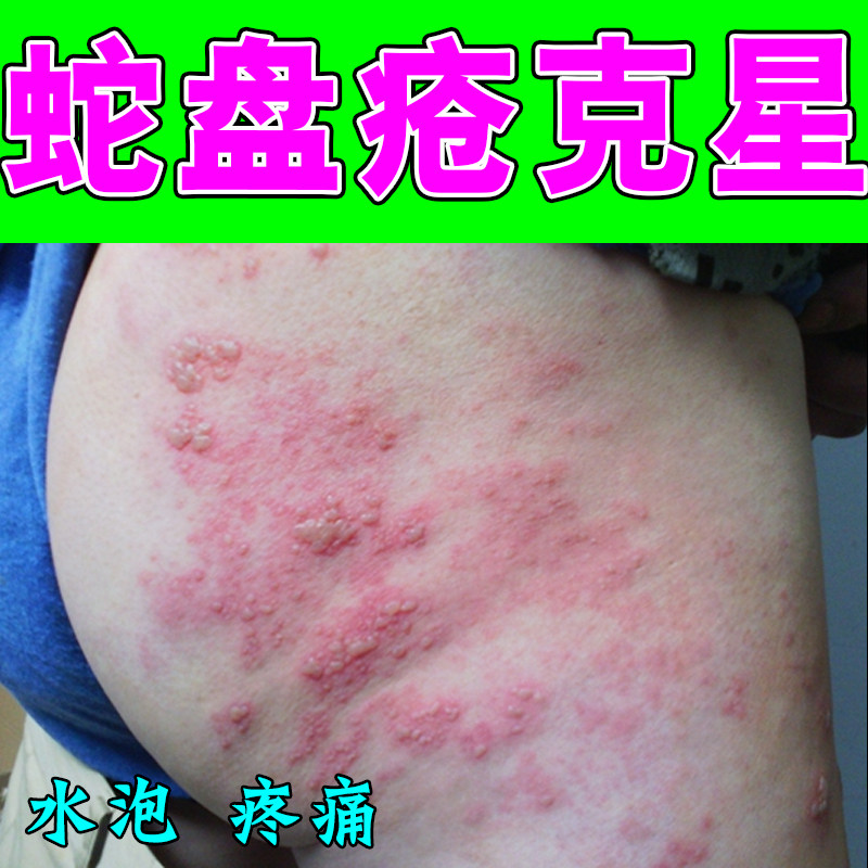 蛇盘疮蜘蛛疮后背上长水泡修复药