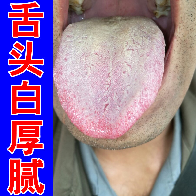 舌苔白厚舌头裂纹湿气重口干口臭舌头灼痛有齿痕舌头泛白草本修护