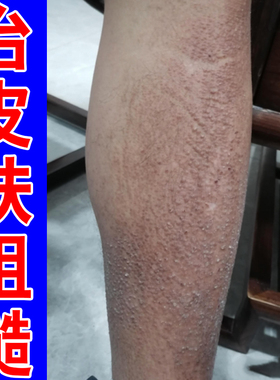 冶皮肤粗糙褐色蛋白沉积顽固后背小腿黑色素沉淀干燥起疙瘩草本药