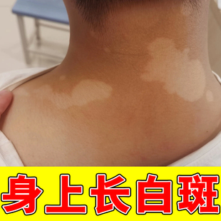 白颠风药乳快速消白斑专用外用黑色素生长补骨脂酊遮盖液神器