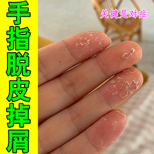 手指脱皮掉屑手指蜕皮季节性手部皮肤干燥粗糙脱皮手掌心裂口子痒