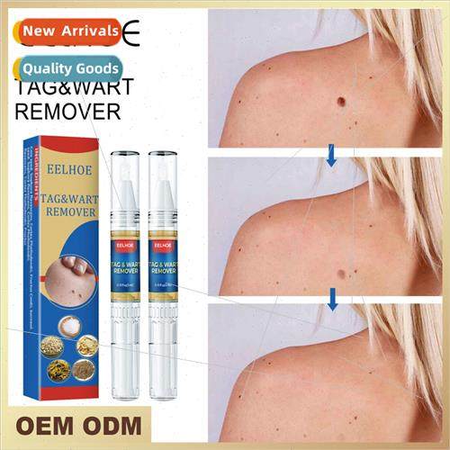 Wart Removal Mole PenKeyu quid Body Skin WartsKeyu Warts Acr