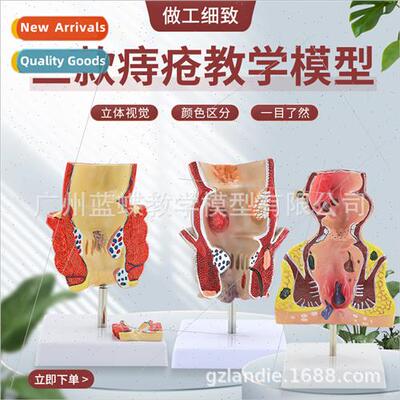 Hemorrhoidal lesion model anal intestinal pathology hemorrho