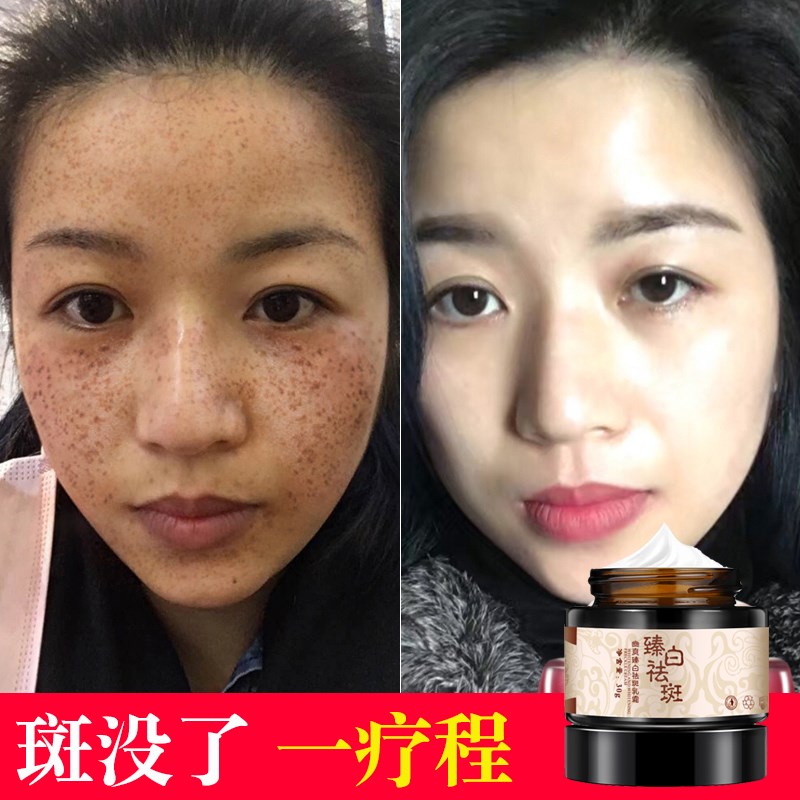 祛斑霜美白面部男女士淡化去除黑色素沉淀脸部色斑脸上学生