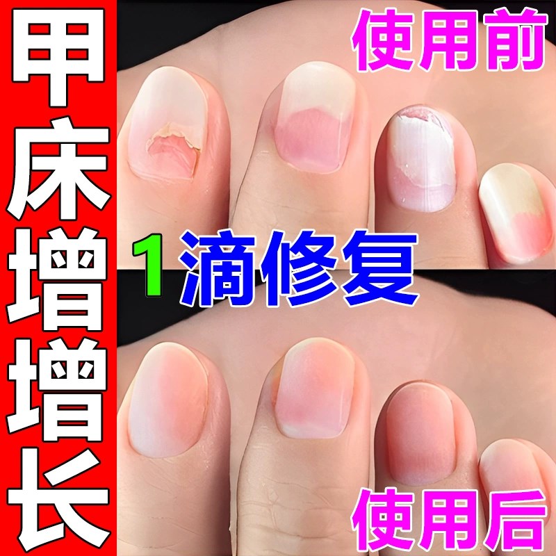 甲床修复生长液啃咬指甲受损萎缩再生甲肉分离空甲断裂护甲油增长