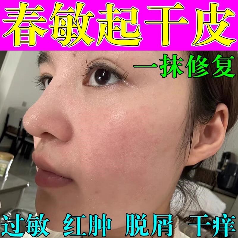 脸上起癣干皮修复皮肤干燥皮起皮屑红痒脸下巴眼皮起癣过敏脱皮药