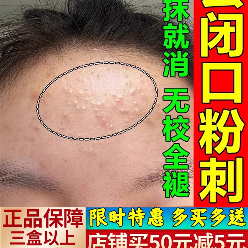 粉刺闭口去除脸部的克。星脸上长痘痘起小疙瘩额头收缩毛孔逆光疹