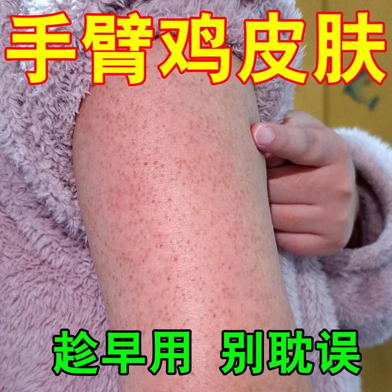 脖子去除手臂鸡皮肤疙毛囊角化药膏胳膊毛孔粗大堵塞红点黑点瘩治