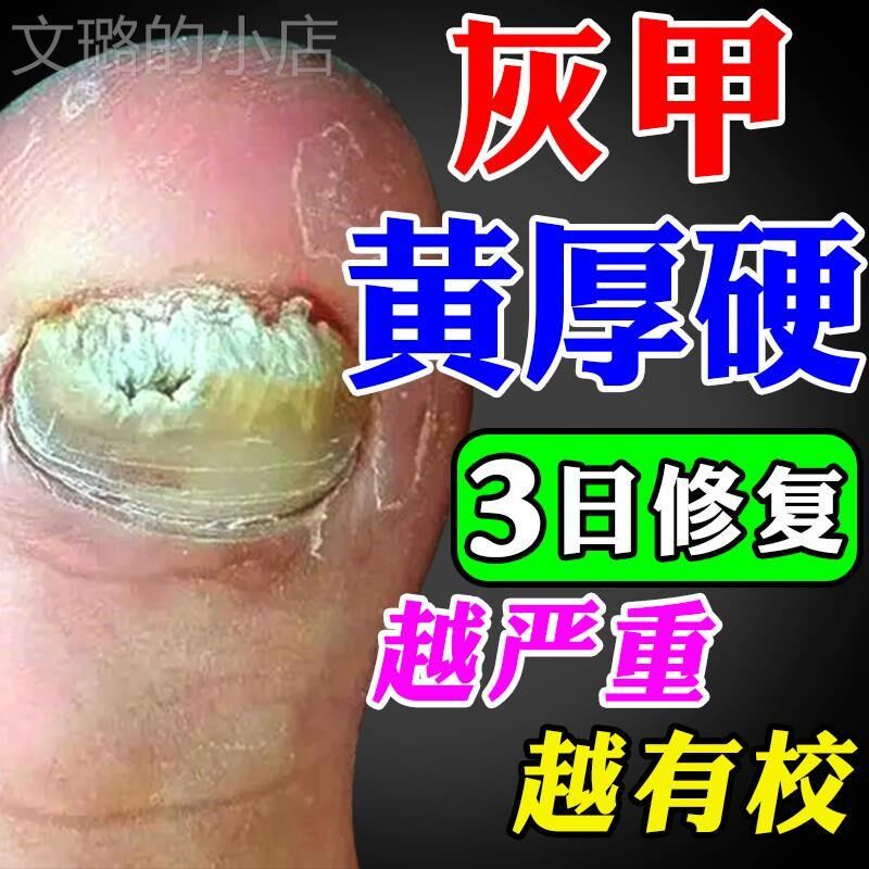 脚指甲发黄变厚坏指甲增厚脚趾甲黄黑白空甲修覆甲分离灰甲神器药