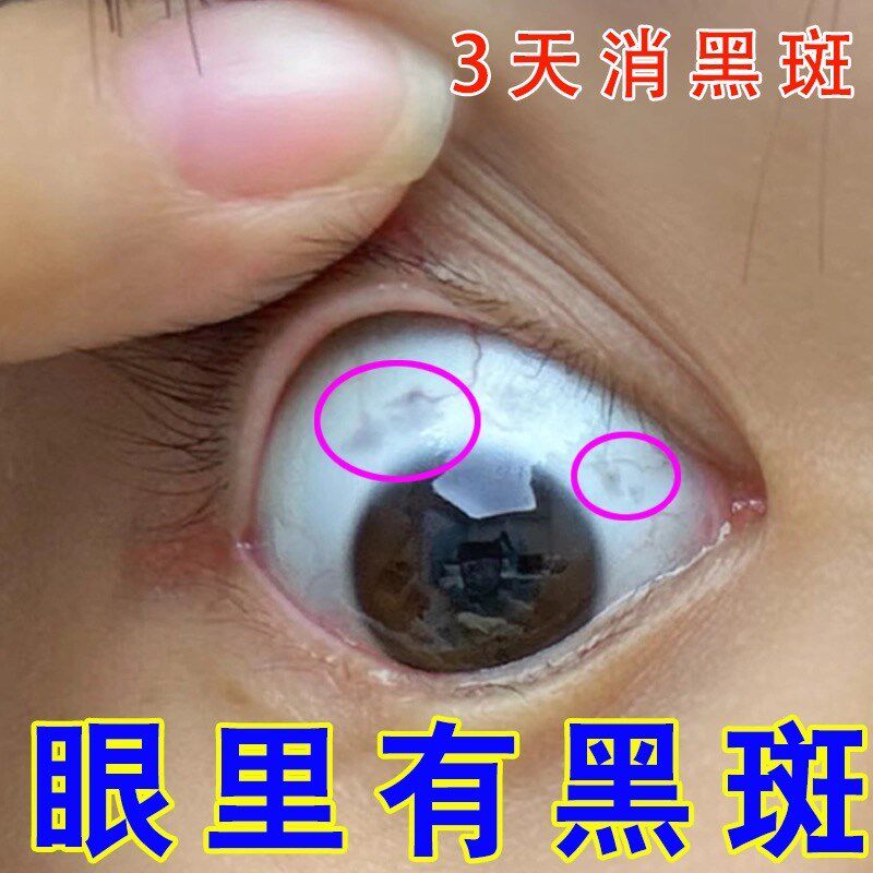 【滴去黑】眼睛黑斑眼白有黑点色素沉淀去除看东西有黑影重影