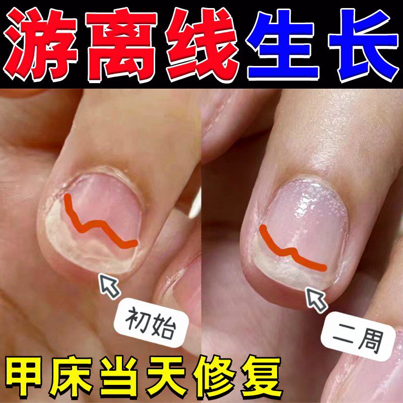 指甲床生长液甲床萎缩分离咬啃指甲开裂专用修覆受损甲床增长增厚
