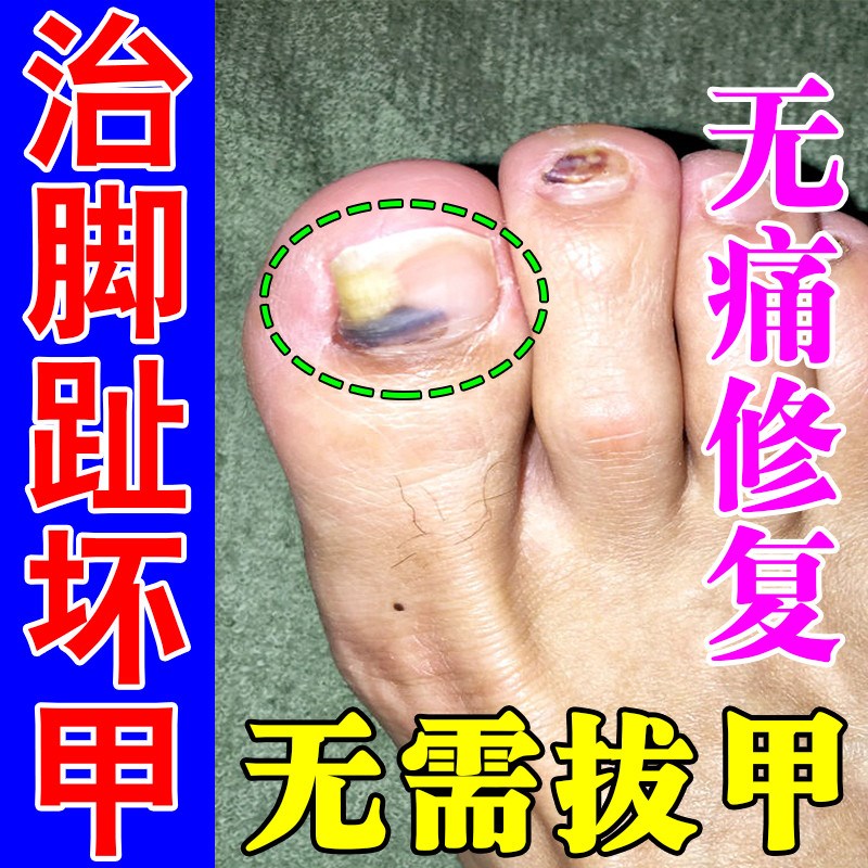 脚指甲盖发黄变厚增厚变硬趾甲真菌性白甲空灰甲床分离修复坏甲液