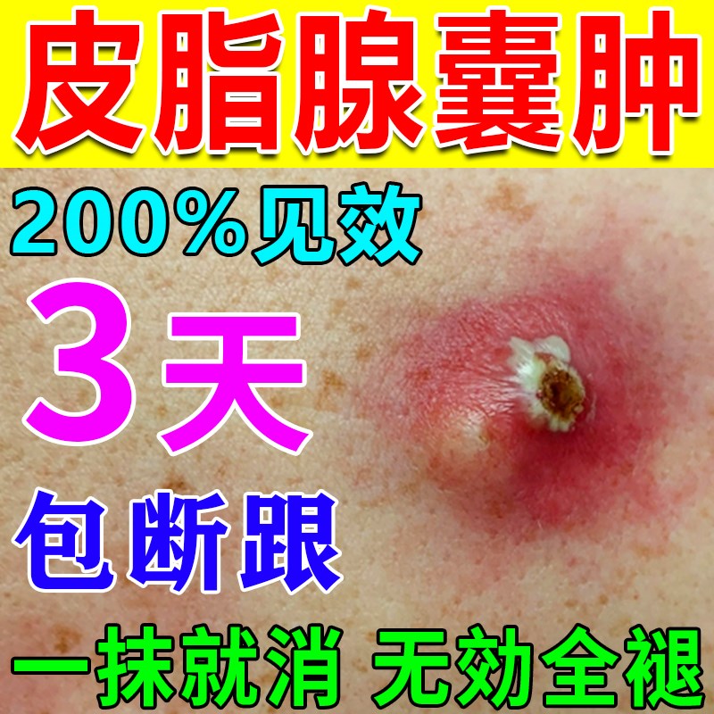 皮脂腺囊肿膏去除皮下囊肿粉瘤脓包痤疮拔脓膏火疖子拔毒神器药