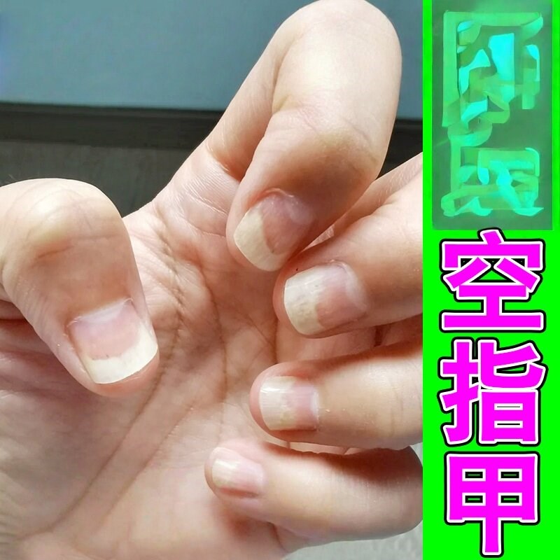 治空甲修复液受损再生手脚指甲变黄硬增厚甲床分离甲/喷雾