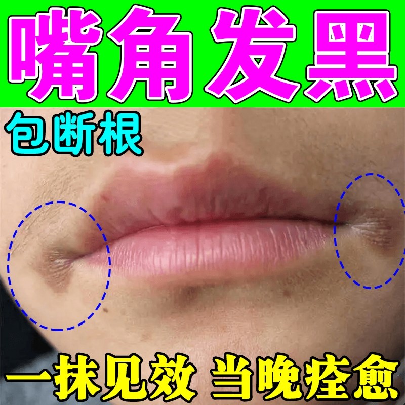 嘴角发黑去除嘴巴周边黑色素暗沉唇纹淡化改善嘴唇干燥起皮专用膏