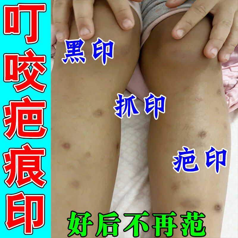 祛疤膏疤痕去黑印黑色素沉淀黑印膏祛腿上黑印修复腿印挠印