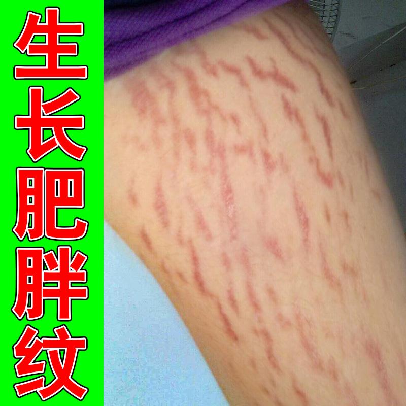 肥胖纹修复霜生长纹肥胖纹严重大腿肥胖纹生长纹激素纹膨胀专用膏