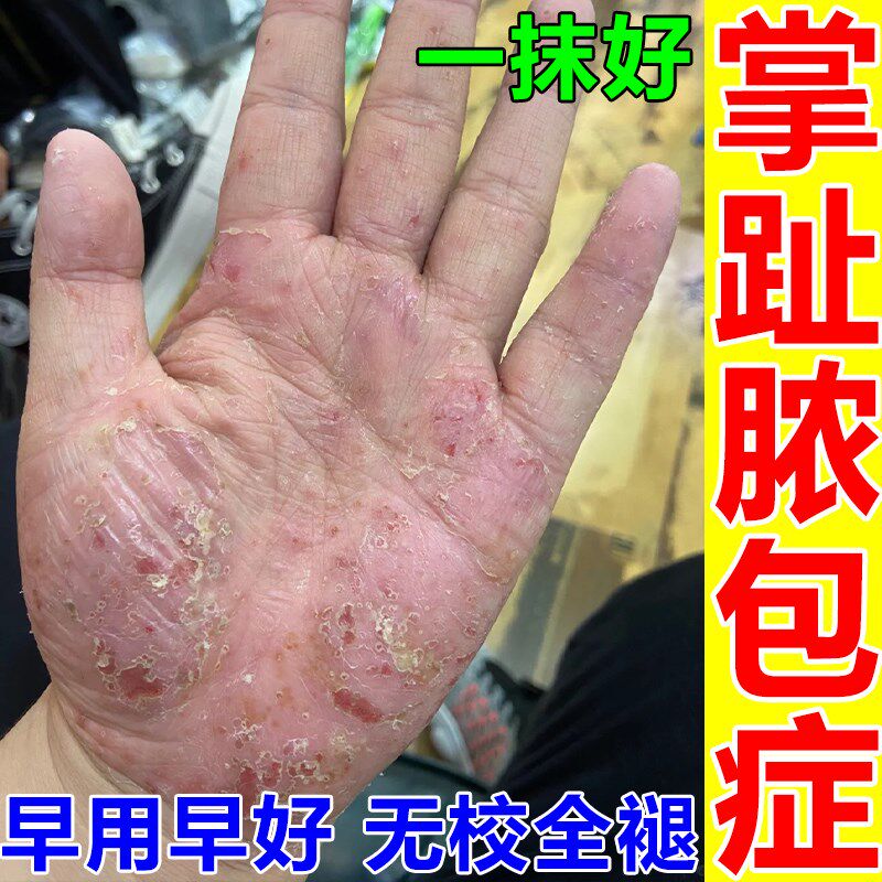 掌趾脓疱病膏掌跖角化症手脚红斑干裂蜕皮角皮症掌跖脓包病