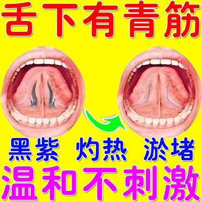 舌下青筋又黑又粗淤血疏通舌头黑紫溶栓液专用口腔舌炎一喷灵喷剂