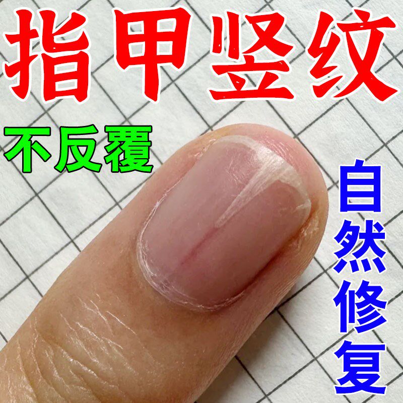 指甲竖纹裂纹克星营养不良甲分离指甲修复液受损再生凹凸不平开裂