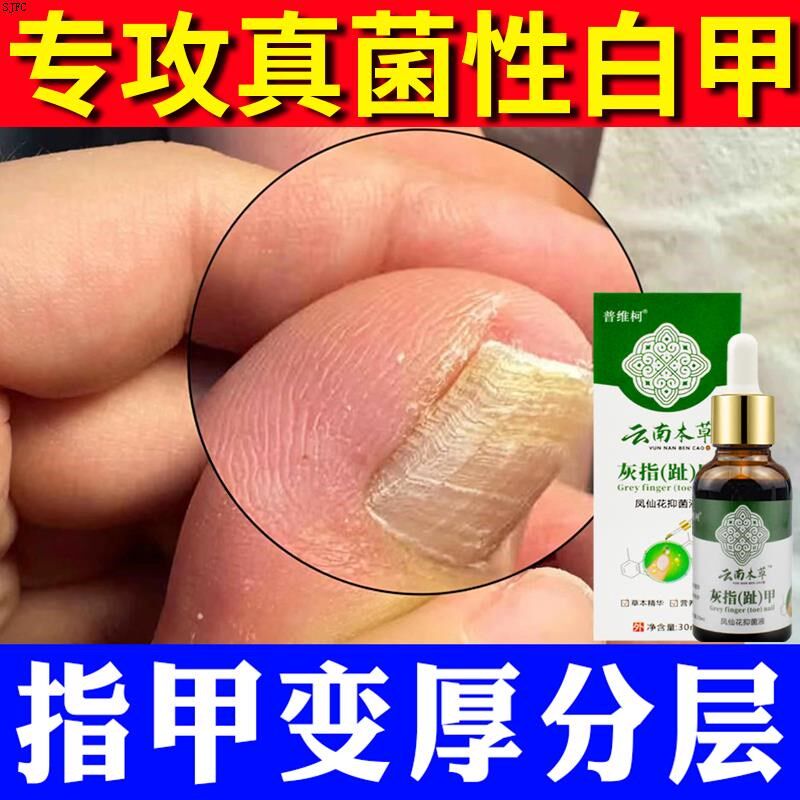 云南本草灰甲凤仙花抑菌液手脚指甲盖发黄增厚变硬真菌性白甲空甲