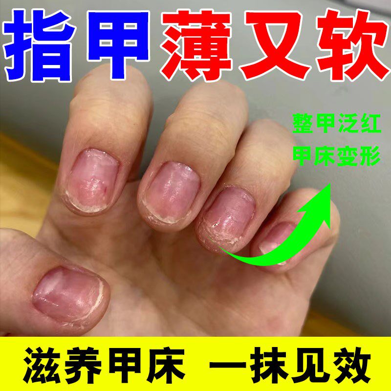 指甲薄软修复防断裂增厚受损甲床甲肉分离竖纹分层护甲再生营养液
