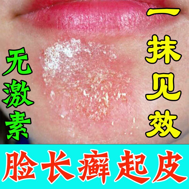脸上长癣皮肤干燥起皮脸上起癣干皮下巴癣皮肤红痒敏感脱皮有碎屑