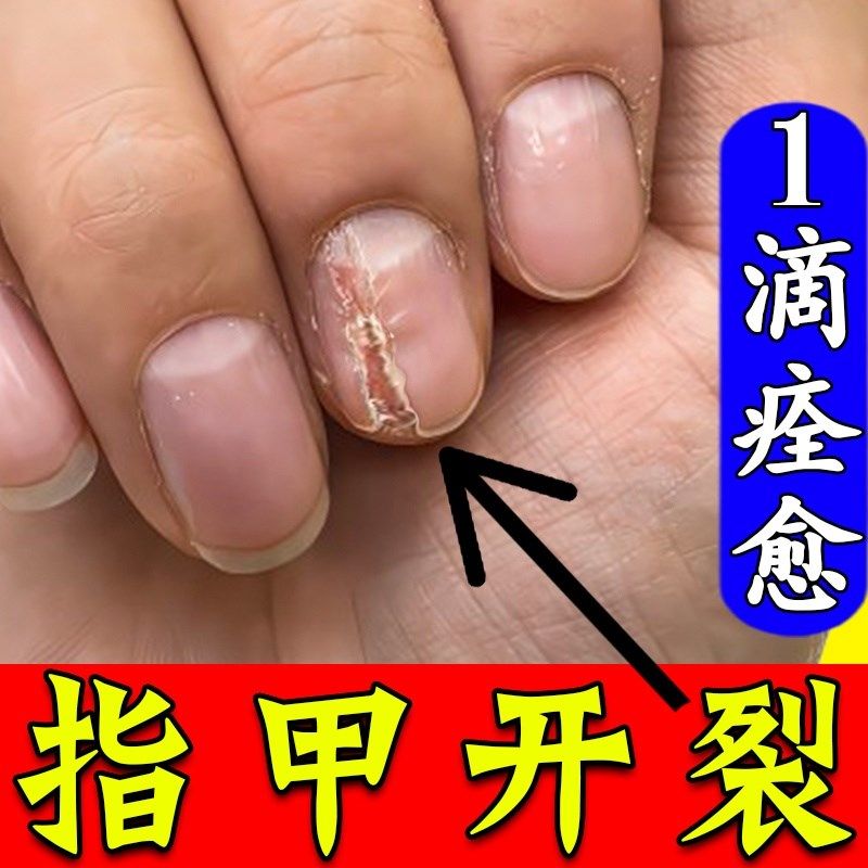 指甲开裂修复甲床分离外伤甲营养不良真菌感染甲癣疼痛出血甲剥离