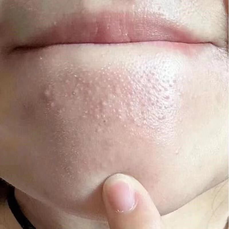 下巴反复长痘痘粉刺脓包毛囊焱高效内分泌调理痘痘去痘痘女士专用