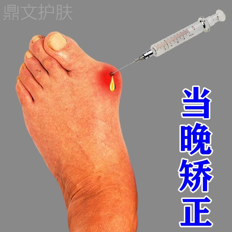 【50年大脚骨一夜直】拇指外翻膏贴拇外翻肌贴大脚骨脚趾矫正器SW