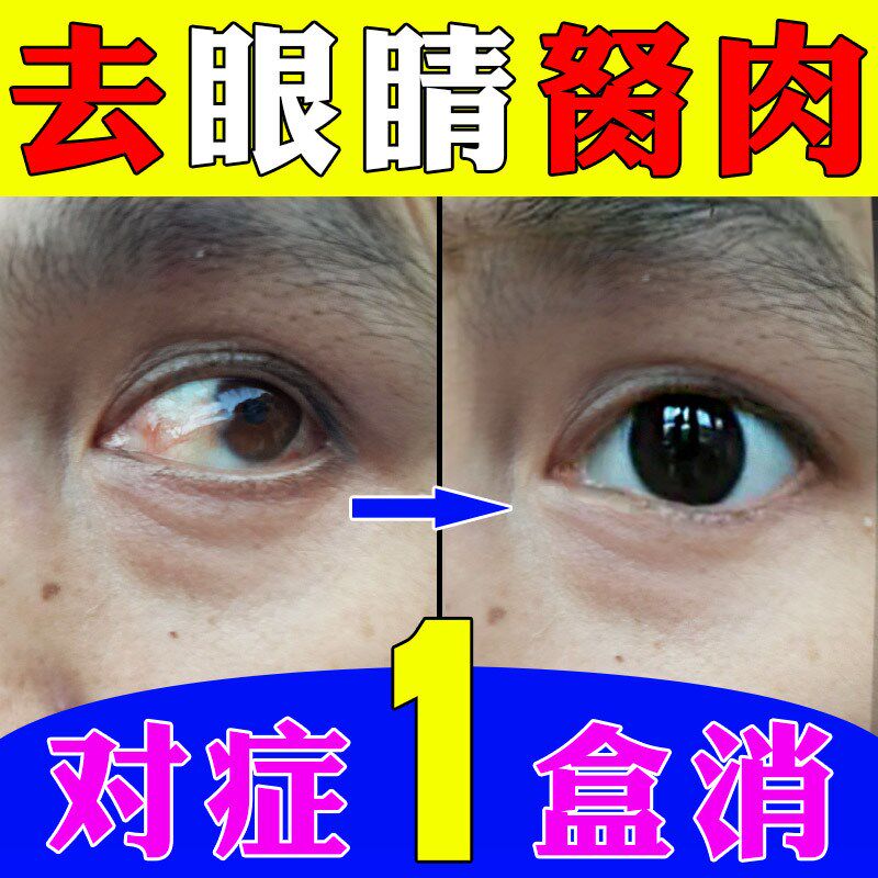 去除眼睛胬肉滴眼液眼睛浑浊看不清有异物翼状疙瘩干痒眼水