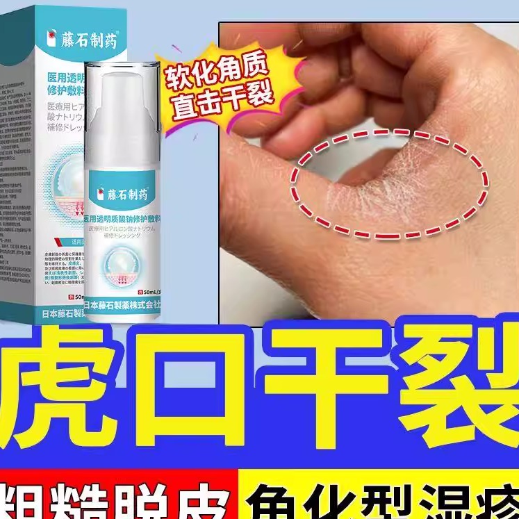 虎口手部角化型干性湿疹脱