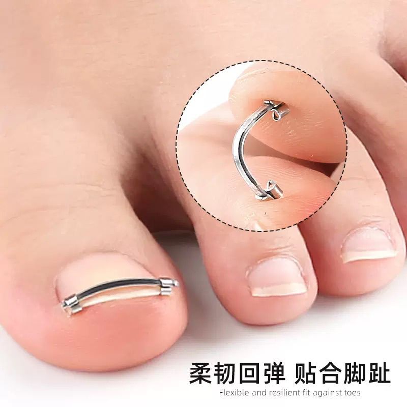 脚指甲盖矫正器不锈钢嵌