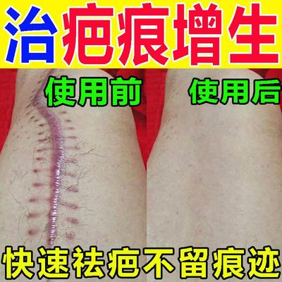 疤痕增生凸起去除胸前瘢痕疙瘩软化针修复油烫伤疤体质痒专用膏