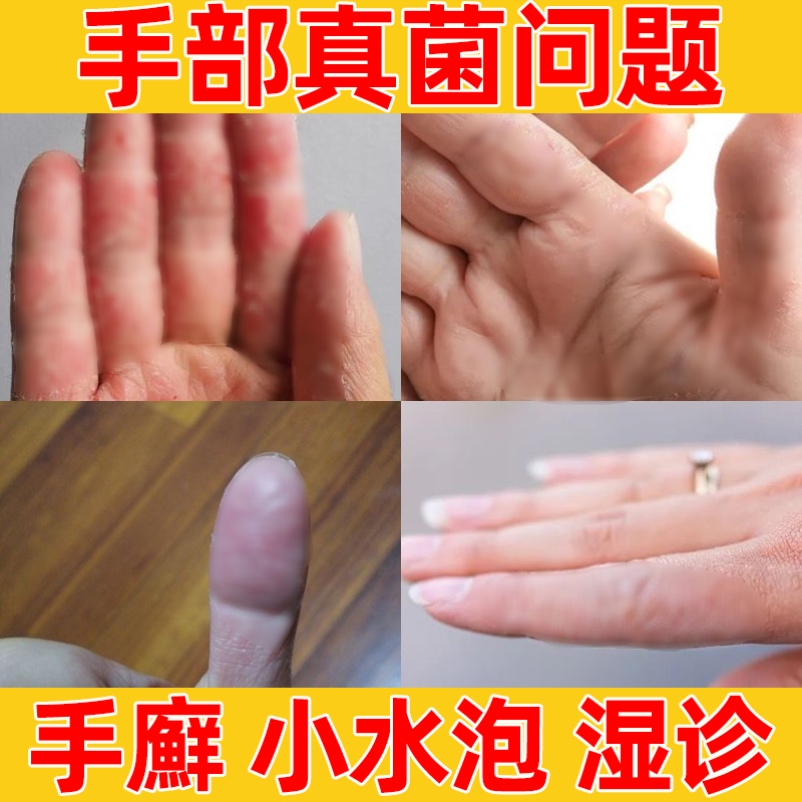 手指真菌感染草本治疗手脱皮的药膏抑制真菌手癣真菌感染手廯痘痘
