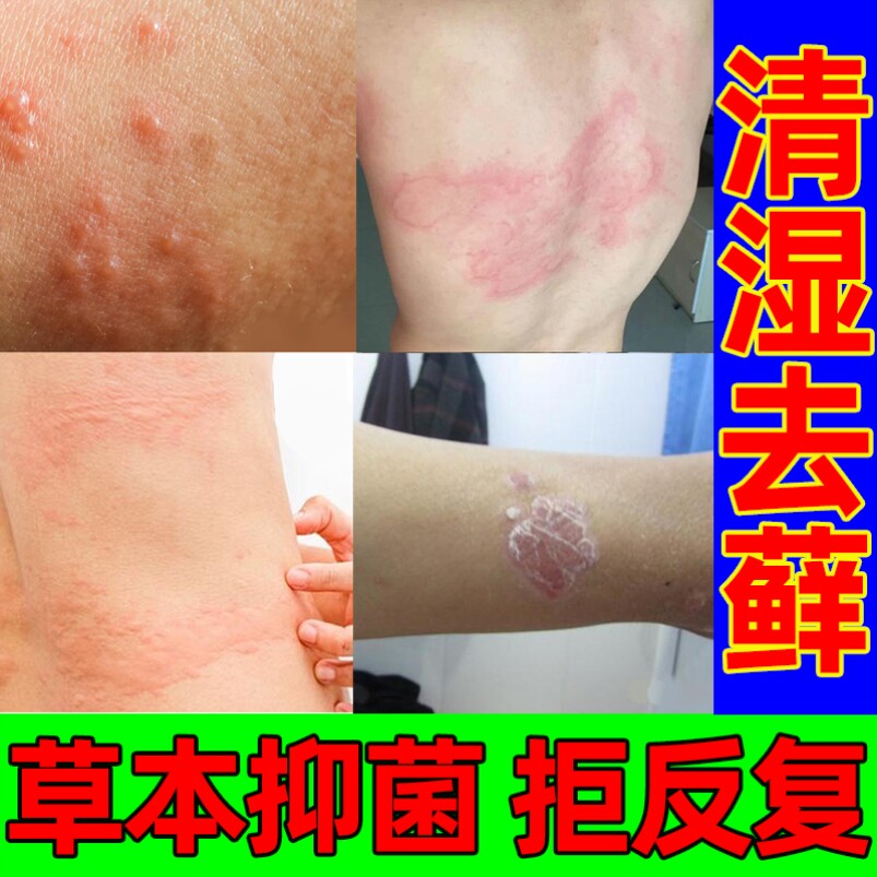 治疗干疮的药治疗真菌感染治手裂的药膏干裂粗糙脱皮外用脱皮药膏