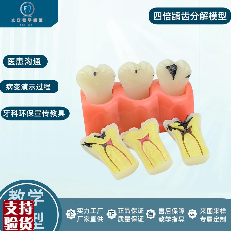 牙模型牙科口腔教学模型窝沟封闭模型龋N齿对比模型龋齿模型