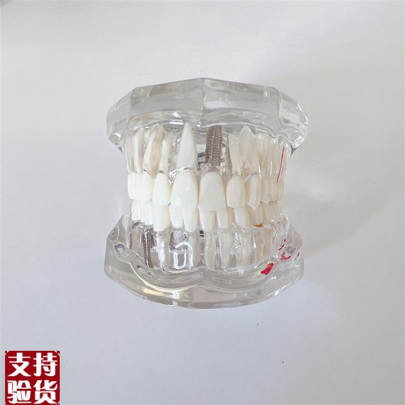 牙齿模型教学模型口腔材料假牙模型口腔模型病理修复Y模型工厂直