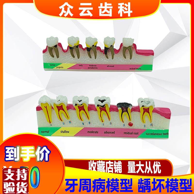 牙齿牙科牙周分类龋坏模型变重过程牙科J口腔医患沟通展示模型包
