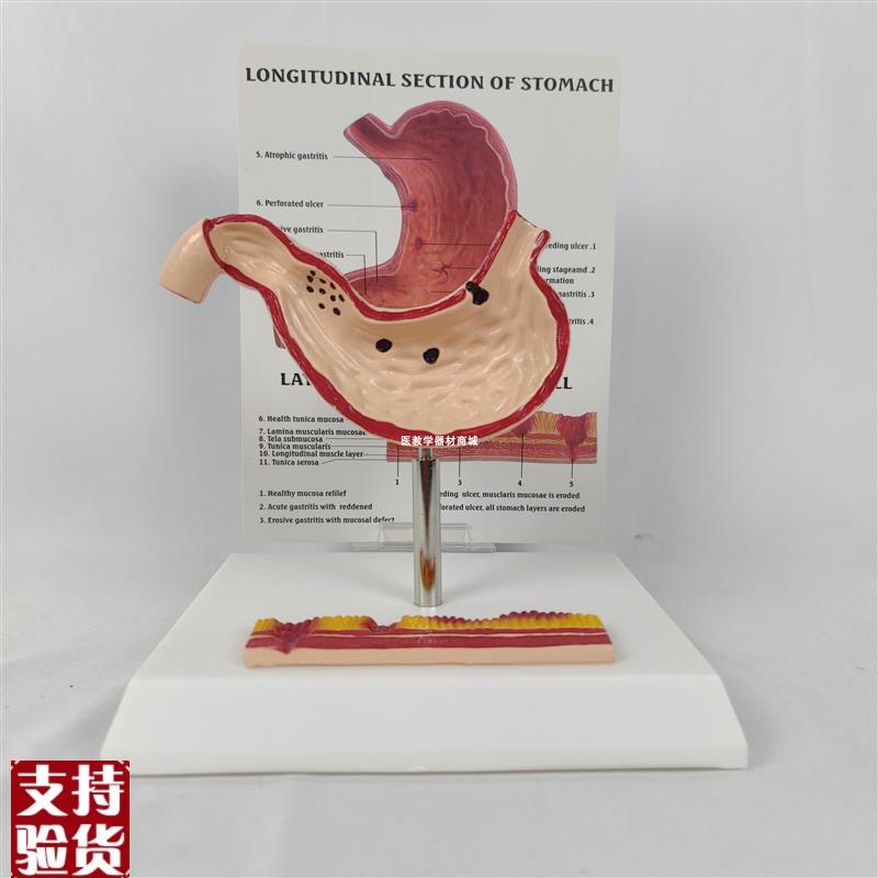 人体病理胃模型胃穿孔胃病胃溃疡A病态胃消化科胃冠状腹腔解剖教