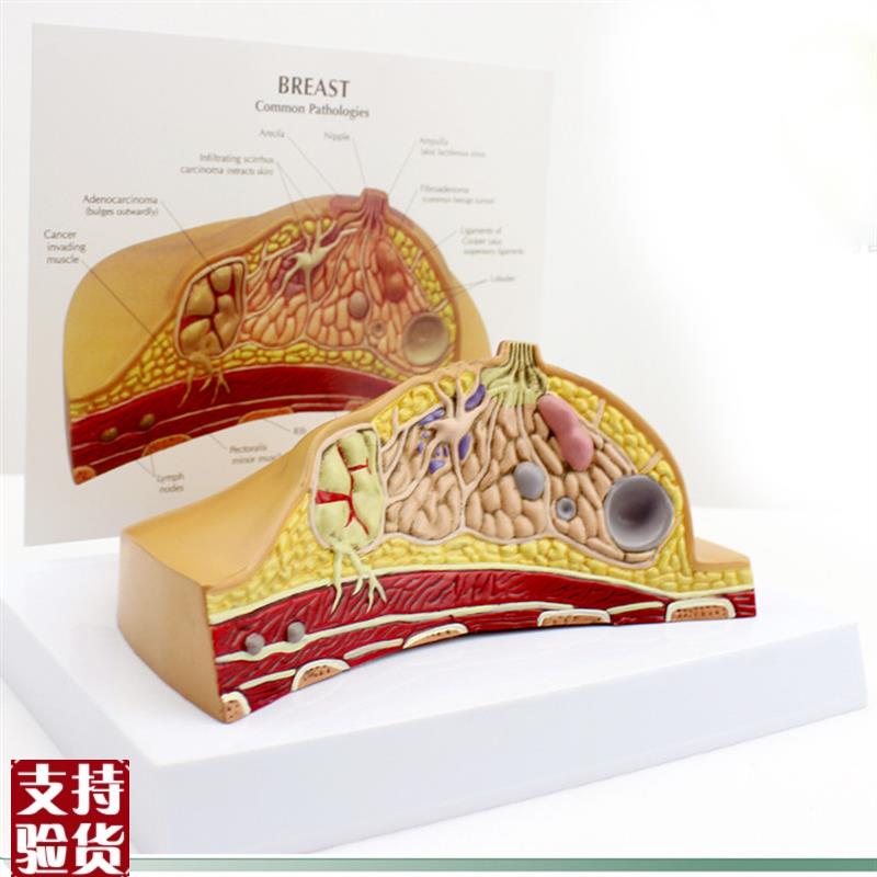 ENOVO颐诺女性乳房常见病解剖模型F乳房乳腺癌肿瘤结节模型母乳哺