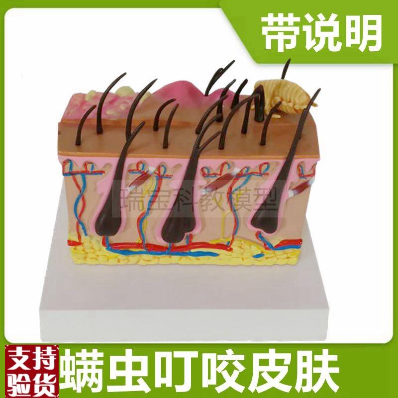 皮肤模型病理蚊虫叮咬p过程皮下病变医美微整形皮肤美容带说明礼
