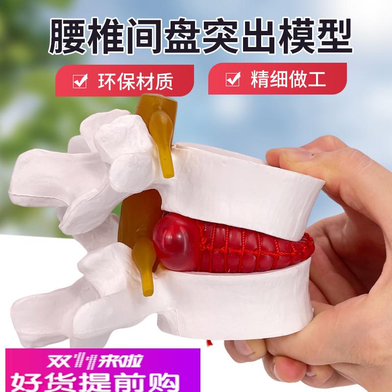 腰椎放大腰椎间盘受压演示模型人体脊柱脊椎骨病理椎间盘膨出模型